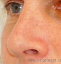 Rhinoplasty Before & After Gallery - Patient 287589 - Image 1
