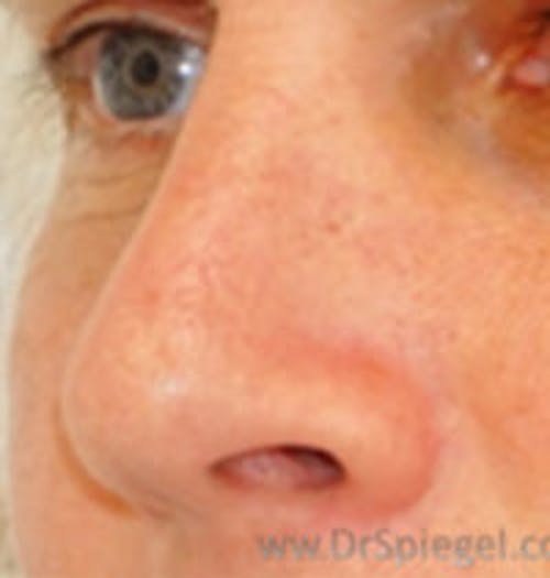 Rhinoplasty Before & After Gallery - Patient 287589 - Image 1