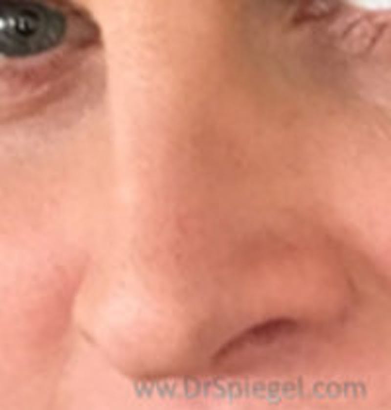 Rhinoplasty Before & After Gallery - Patient 287589 - Image 2