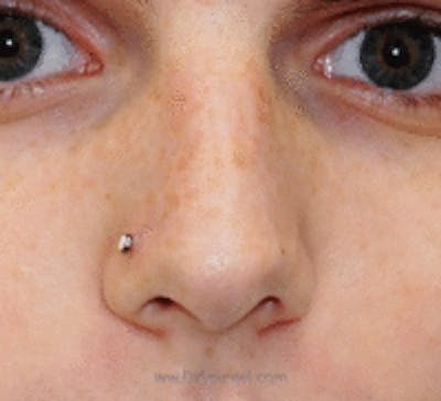 Rhinoplasty Before & After Gallery - Patient 427978 - Image 1