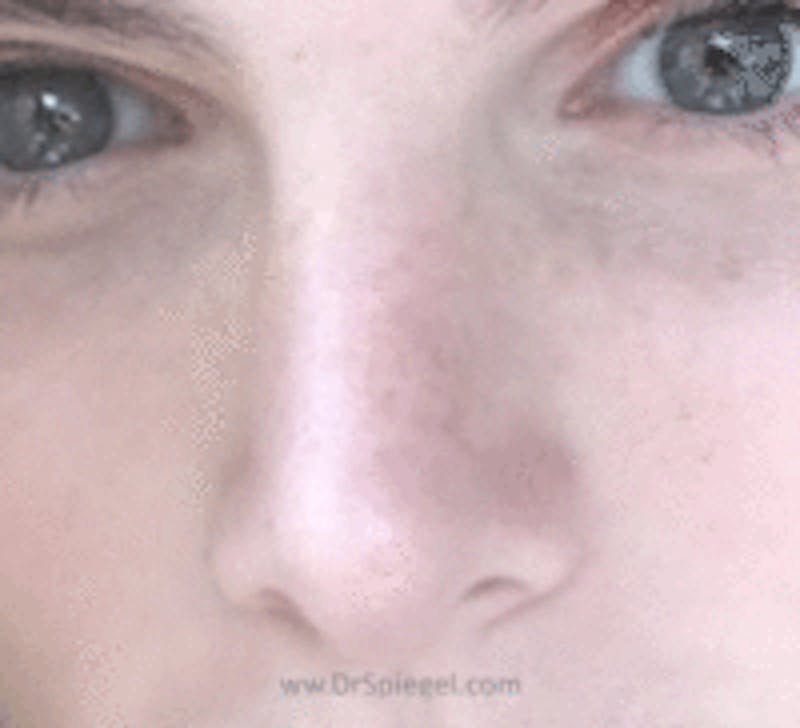 Rhinoplasty Before & After Gallery - Patient 427978 - Image 2