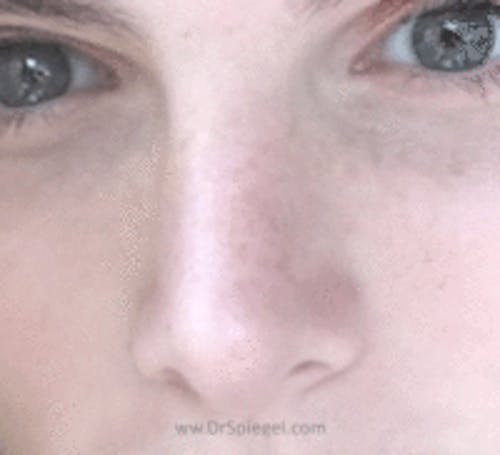 Rhinoplasty Before & After Gallery - Patient 427978 - Image 2