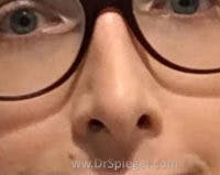 Rhinoplasty Before & After Gallery - Patient 337579 - Image 2