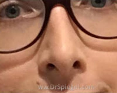 Rhinoplasty Before & After Gallery - Patient 337579 - Image 2