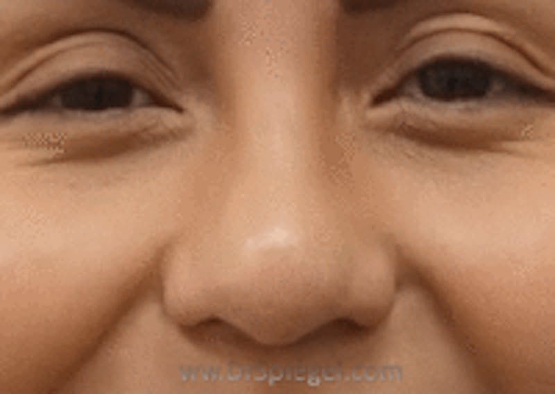 Rhinoplasty Before & After Gallery - Patient 299235 - Image 1