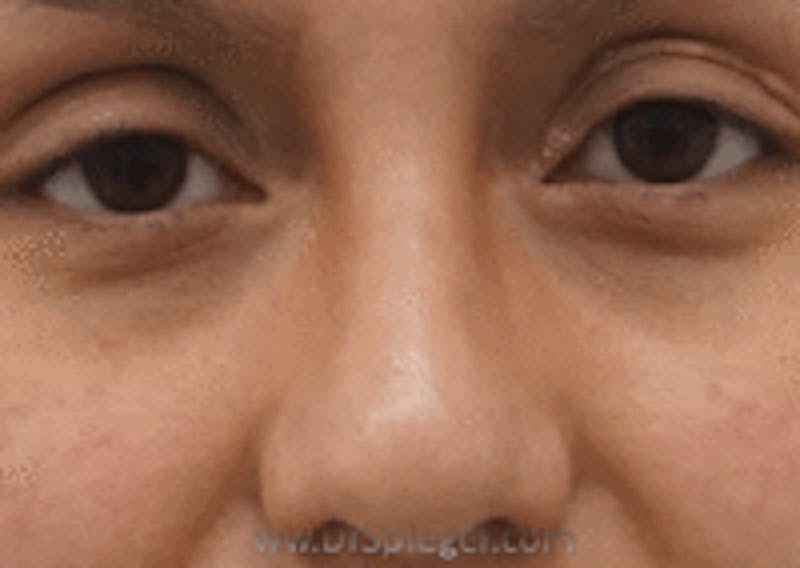 Rhinoplasty Before & After Gallery - Patient 299235 - Image 2