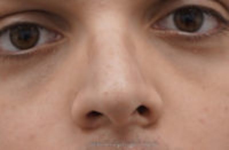 Rhinoplasty Before & After Gallery - Patient 311323 - Image 1