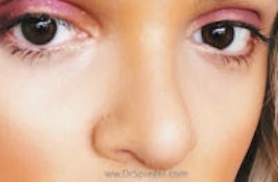 Rhinoplasty Before & After Gallery - Patient 311323 - Image 2