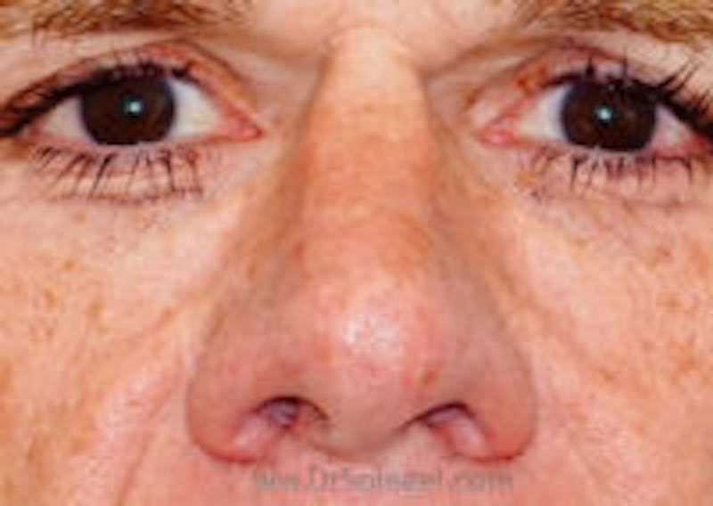 Rhinoplasty Before & After Gallery - Patient 734447 - Image 1