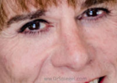 Rhinoplasty Before & After Gallery - Patient 734447 - Image 2