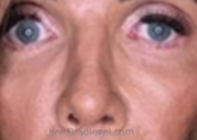 Rhinoplasty Before & After Gallery - Patient 191461 - Image 2