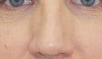 Rhinoplasty Before & After Gallery - Patient 241293 - Image 1