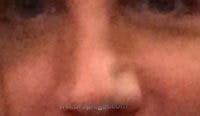 Rhinoplasty Before & After Gallery - Patient 241293 - Image 2