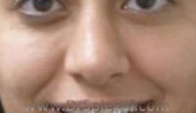 Rhinoplasty Before & After Gallery - Patient 836504 - Image 1