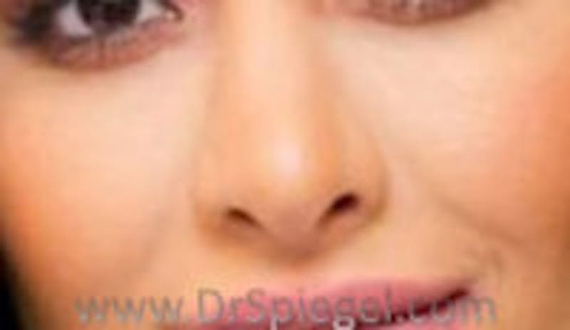 Rhinoplasty Before & After Gallery - Patient 836504 - Image 2