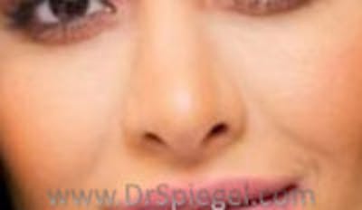 Rhinoplasty Before & After Gallery - Patient 836504 - Image 2