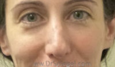 Rhinoplasty Before & After Gallery - Patient 423155 - Image 1