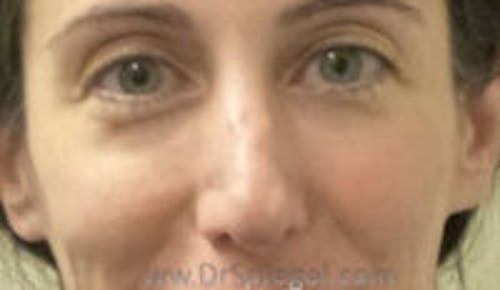 Rhinoplasty Before & After Gallery - Patient 423155 - Image 1