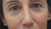 Rhinoplasty Before & After Gallery - Patient 423155 - Image 2