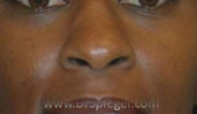 Rhinoplasty Before & After Gallery - Patient 813736 - Image 1