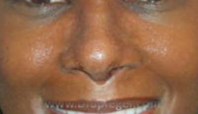 Rhinoplasty Before & After Gallery - Patient 813736 - Image 2