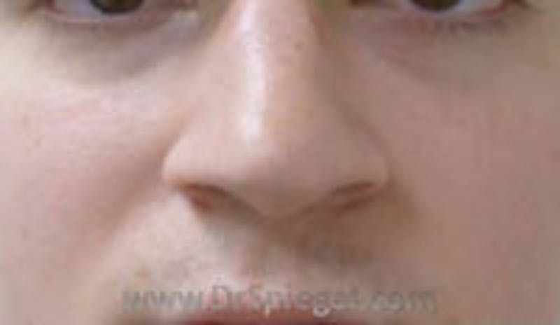 Rhinoplasty Before & After Gallery - Patient 146932 - Image 1