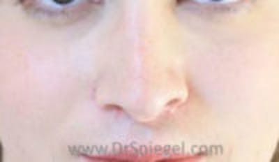 Rhinoplasty Before & After Gallery - Patient 146932 - Image 2