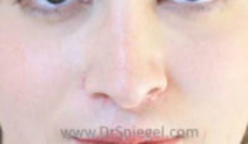 Rhinoplasty Before & After Gallery - Patient 146932 - Image 2