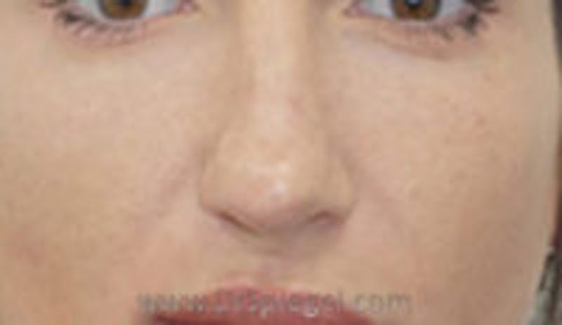 Rhinoplasty Before & After Gallery - Patient 347196 - Image 1