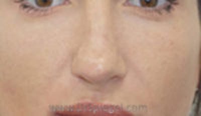 Rhinoplasty Before & After Gallery - Patient 347196 - Image 1