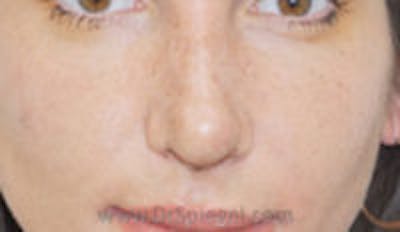 Rhinoplasty Before & After Gallery - Patient 347196 - Image 2