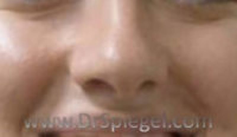 Rhinoplasty Before & After Gallery - Patient 452111 - Image 1