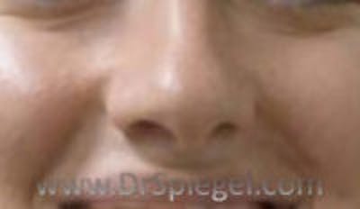 Rhinoplasty Before & After Gallery - Patient 452111 - Image 1