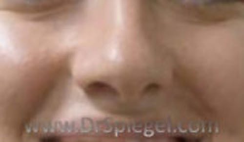 Rhinoplasty Before & After Gallery - Patient 452111 - Image 1