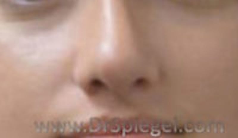 Rhinoplasty Before & After Gallery - Patient 452111 - Image 2