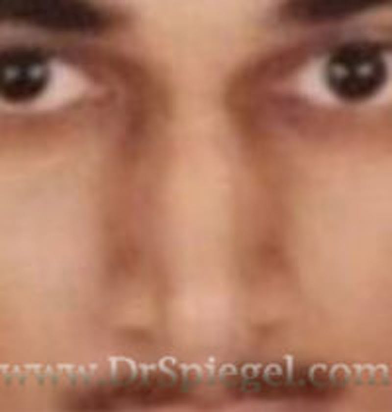 Rhinoplasty Before & After Gallery - Patient 173298 - Image 1