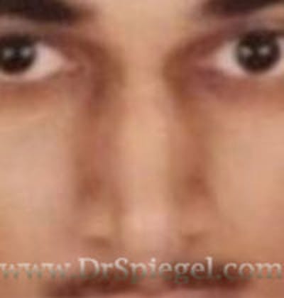 Rhinoplasty Before & After Gallery - Patient 173298 - Image 1