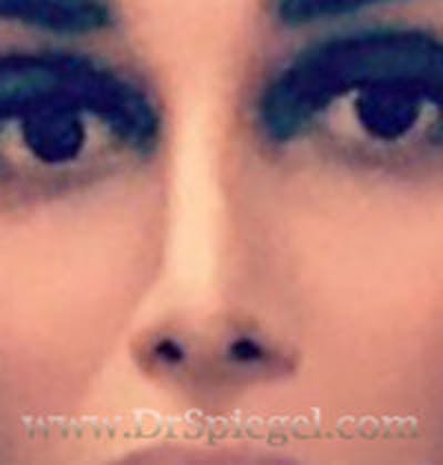 Rhinoplasty Before & After Gallery - Patient 173298 - Image 2