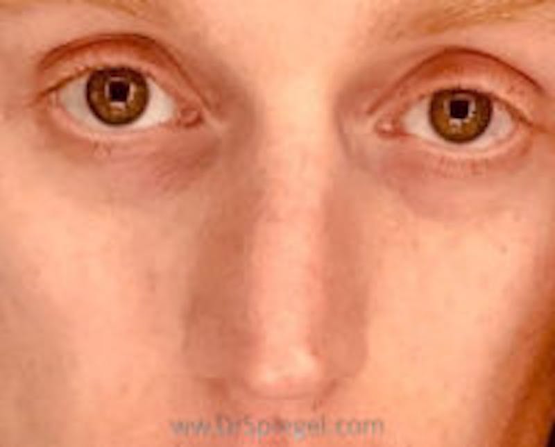 Rhinoplasty Before & After Gallery - Patient 204868 - Image 1