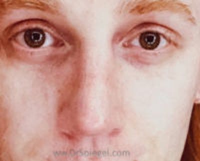 Rhinoplasty Before & After Gallery - Patient 204868 - Image 2