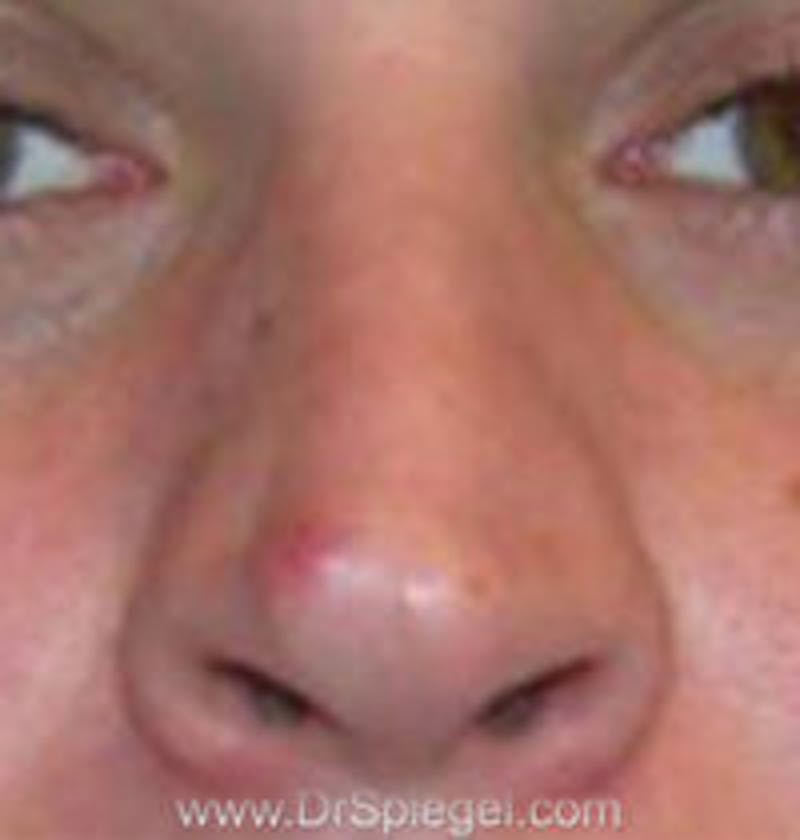 Rhinoplasty Before & After Gallery - Patient 637694 - Image 1