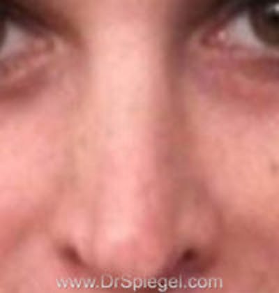 Rhinoplasty Before & After Gallery - Patient 637694 - Image 2