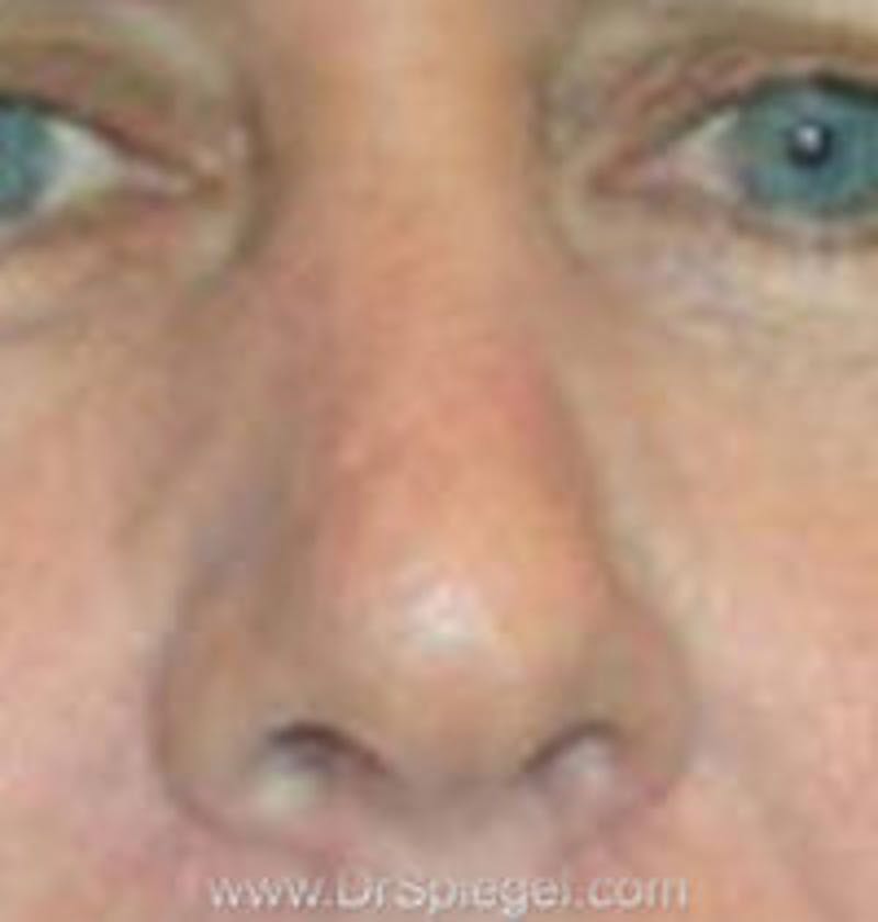 Rhinoplasty Before & After Gallery - Patient 327539 - Image 1