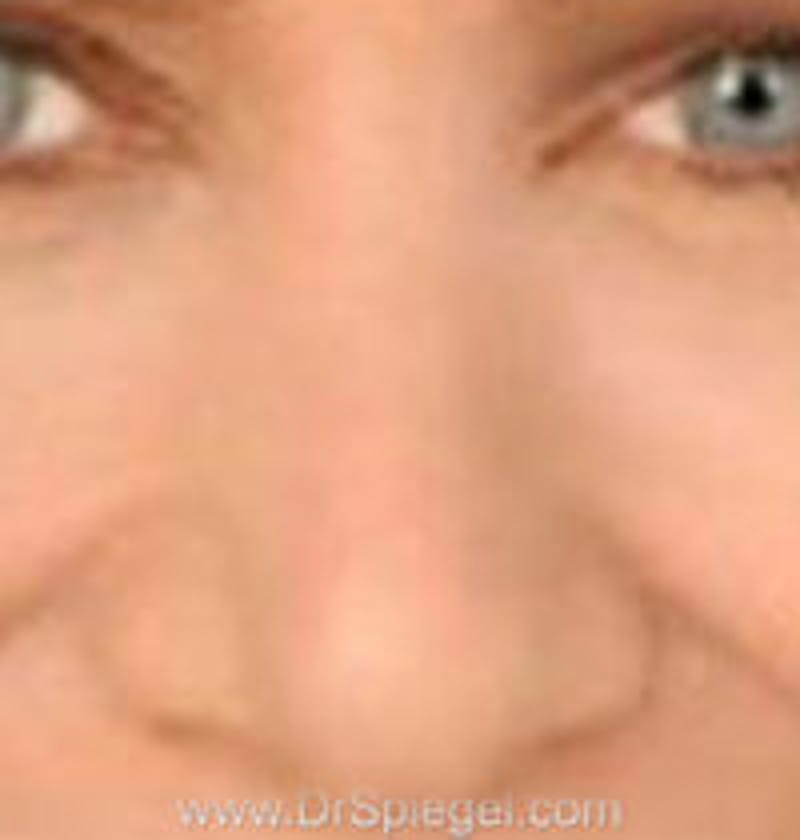 Rhinoplasty Before & After Gallery - Patient 327539 - Image 2