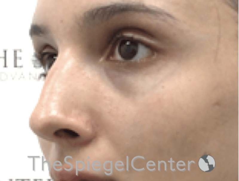 Revision Rhinoplasty Before & After Gallery - Patient 485659 - Image 1