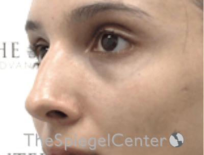 Revision Rhinoplasty Before & After Gallery - Patient 485659 - Image 1