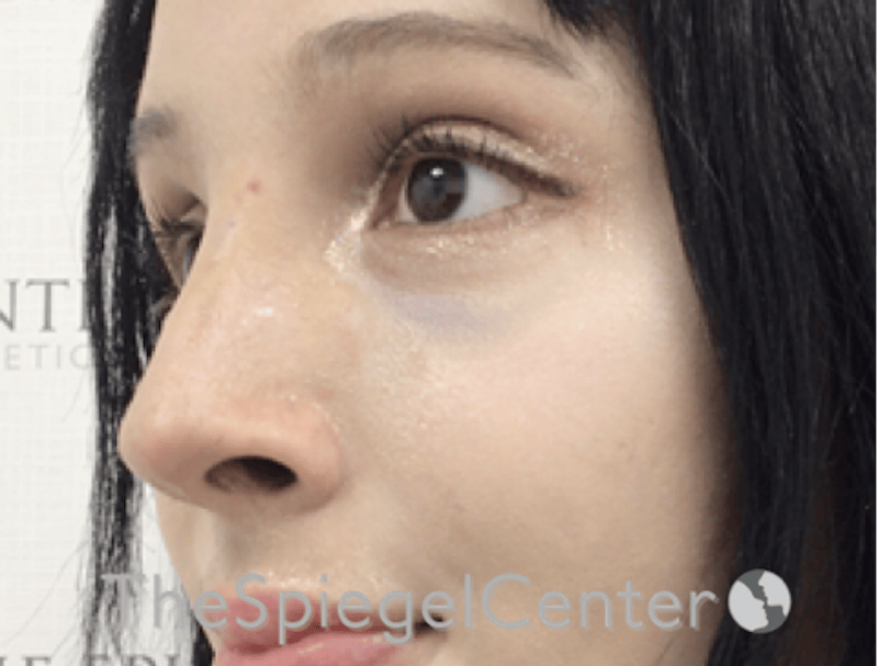 Revision Rhinoplasty Before & After Gallery - Patient 485659 - Image 2