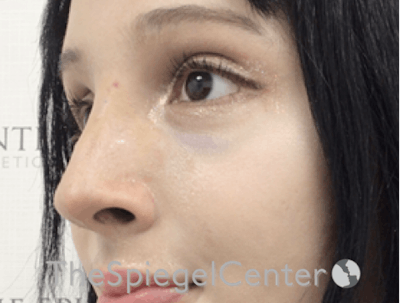 Revision Rhinoplasty Before & After Gallery - Patient 485659 - Image 2