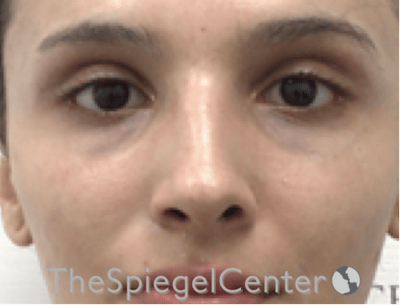 Revision Rhinoplasty Before & After Gallery - Patient 485659 - Image 3