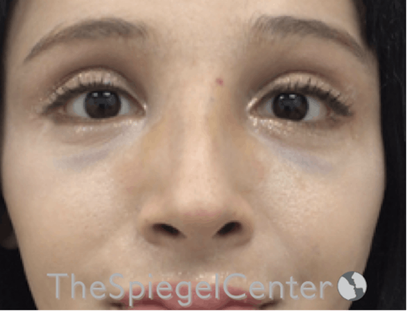 Revision Rhinoplasty Before & After Gallery - Patient 485659 - Image 4